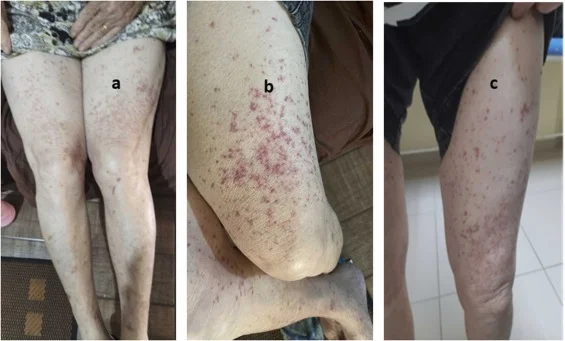 Three photos of lower legs showing multiple red and purple skin lesions and inflamed patches.