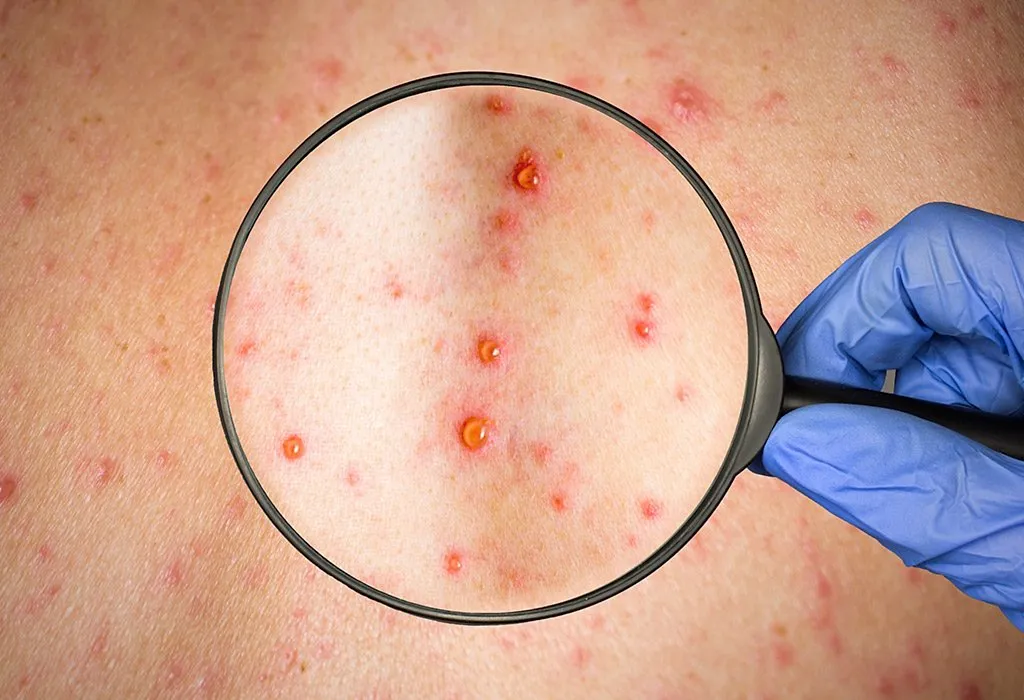 A magnifying glass held by a gloved hand shows a close-up of small, red, fluid-filled blisters on the skin.