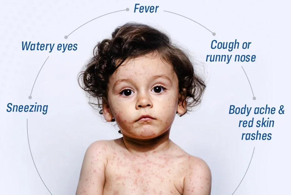 Infographic of a child with a red rash, listing symptoms: sneezing, watery eyes, fever, cough/runny nose, and body aches.