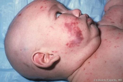 Infant lying on medical sheet with reddish-purple lesions on face, neck, and upper torso.