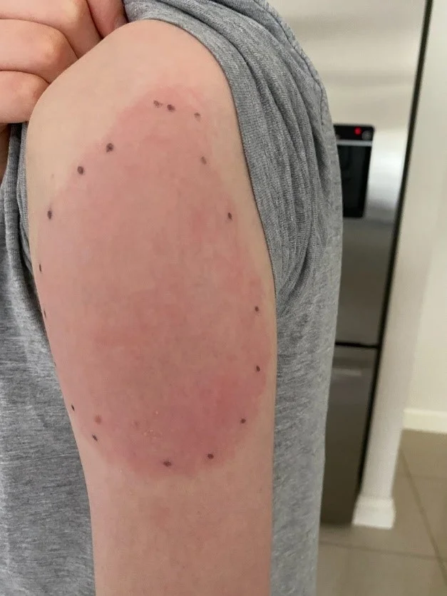 Upper arm with circular red rash surrounded by small dark dots.