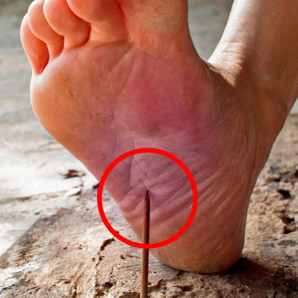 Close-up of a bare foot stepping on a rusty nail, highlighting risk of tetanus infection from puncture wound.