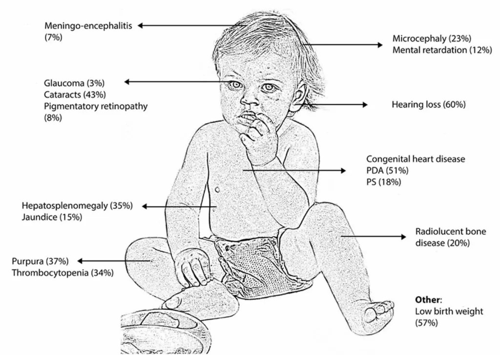 Black-and-white diagram of an infant annotated with various congenital abnormalities and their prevalence percentages across the body.