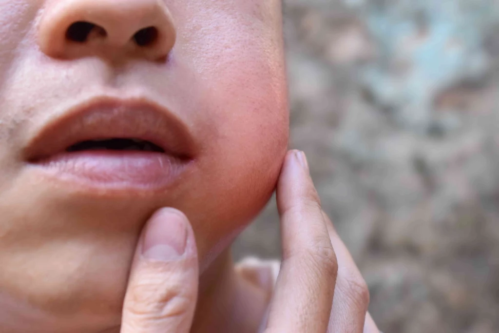 Close-up of a person touching a visibly swollen and red cheek and jaw area.