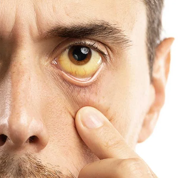 Close-up of eye with yellowish sclera indicating jaundice.