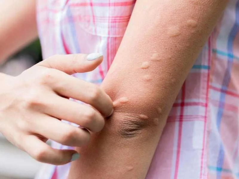 Close-up of forearm with multiple red bumps being scratched.